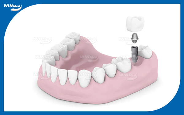 Implant cho phòng khám nhỏ