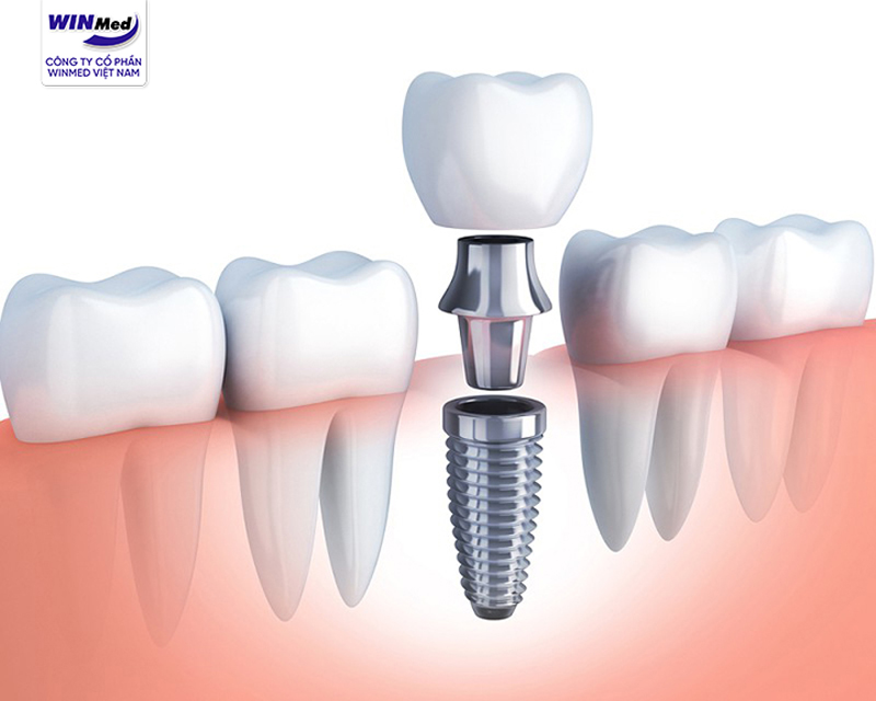 Nhược điểm của trồng răng implant