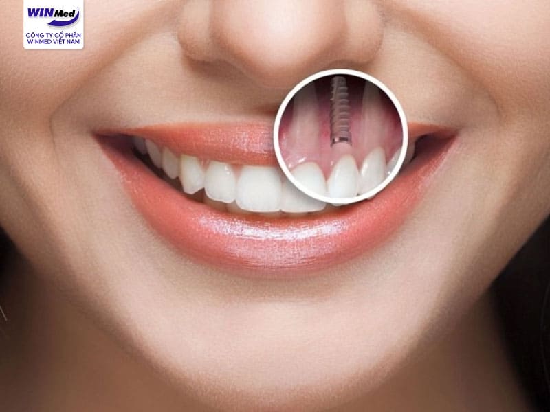 Cần lưu ý các trường hợp nêu trên để tránh ảnh hưởng đến sức khỏe khi trồng răng implant