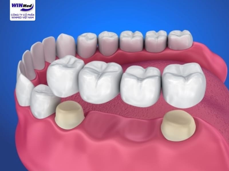 Cầu răng sứ là gì