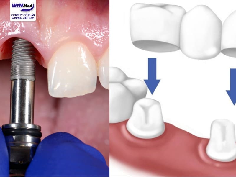 Nên chọn trồng răng Implant hay cầu răng sứ