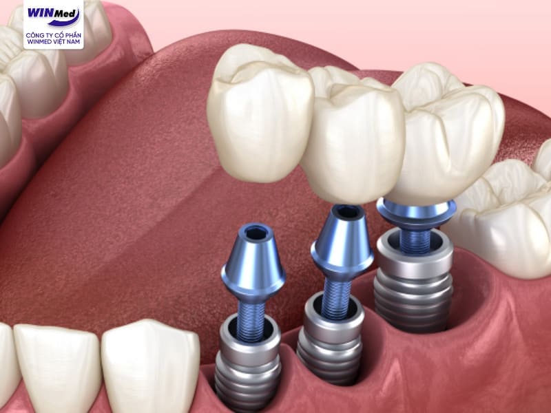 Implant là gì