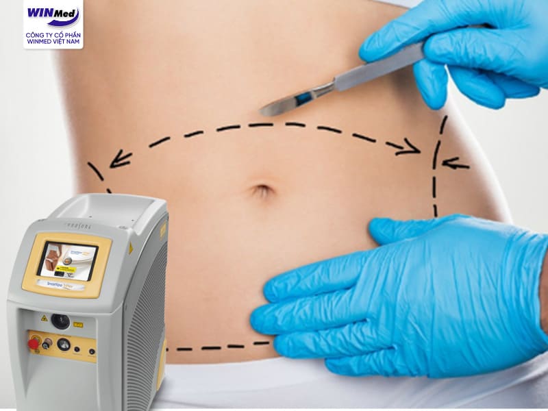 Máy hút mỡ Smartlipo Triplex – Công nghệ Laser hiện đại