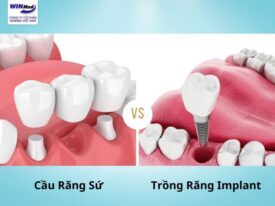 Nên chọn trồng răng Implant hay cầu răng sứ