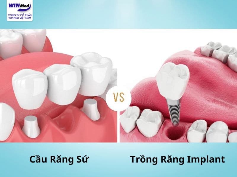 Nên chọn trồng răng Implant hay cầu răng sứ
