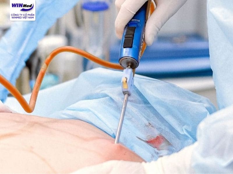 Body Jet có khả năng loại bỏ mỡ thừa tại nhiều vùng cơ thể