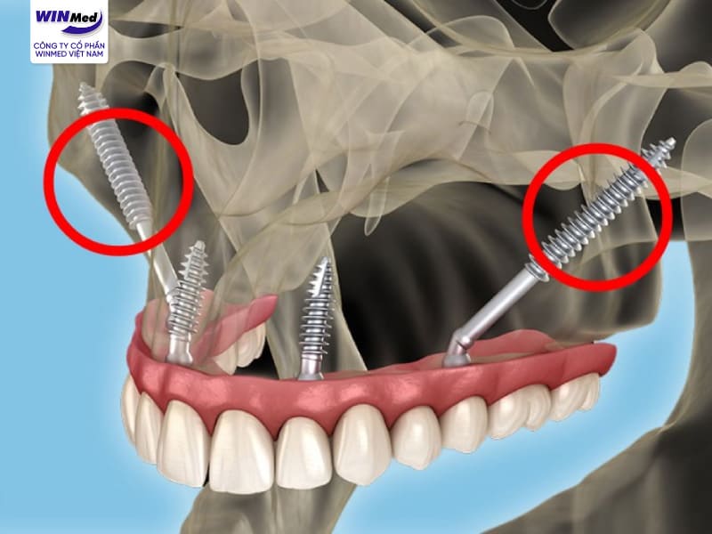 Cấy ghép Implant xương gò má chủ yếu được chỉ định của Bác sĩ với các trường hợp phù hợp