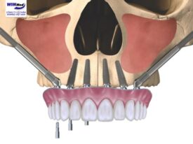 Implant xương gò má – giải pháp cho người mất răng lâu năm
