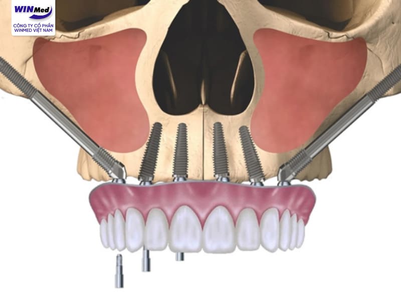 Implant xương gò má – giải pháp cho người mất răng lâu năm