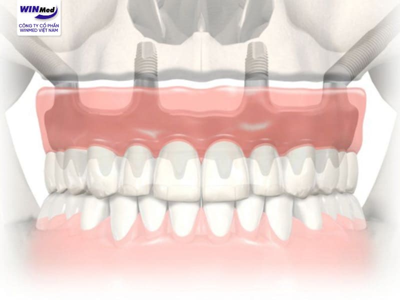 Implant gò má là một kỹ thuật áp dụng cho những bệnh nhân mất răng toàn hàm trên