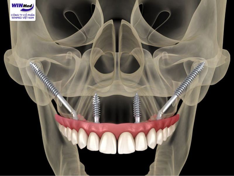 Implant xương gò má là một thủ thuật phức tạp, mất nhiều thời gian
