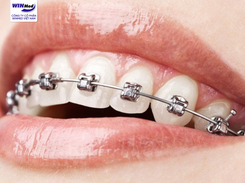 Mắc cài kim loại là loại mắc cài lâu đời nhất trong lịch sử ngành chỉnh nha
