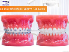 Mắc cài kim loại và mắc cài sứ: Đâu là giải pháp tối ưu cho nụ cười đẹp?