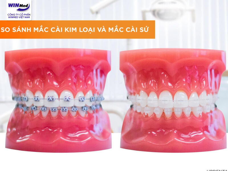 Mắc cài kim loại và mắc cài sứ: Đâu là giải pháp tối ưu cho nụ cười đẹp?