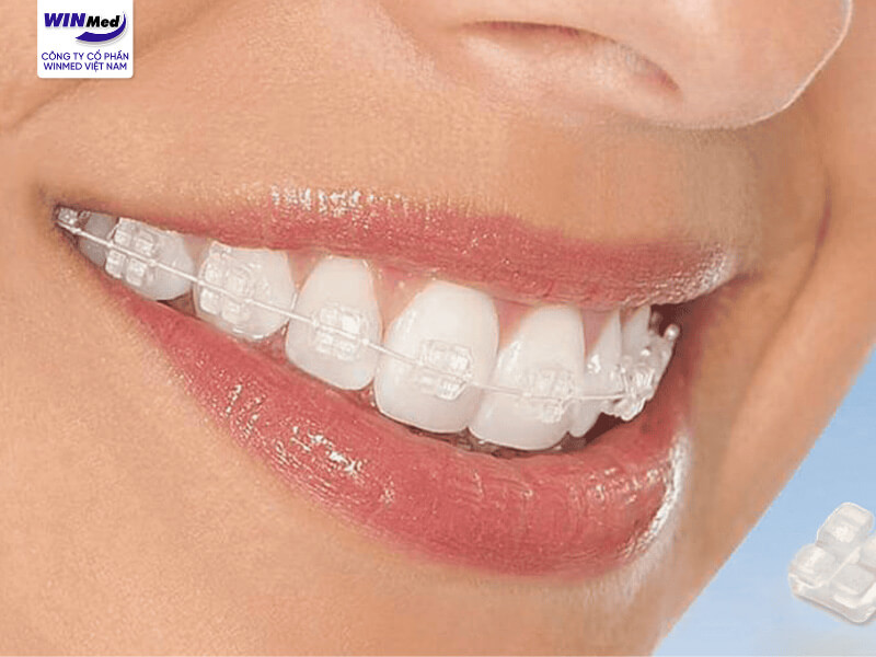 Mắc cài sứ ra đời như một bước tiến lớn trong lĩnh vực chỉnh nha thẩm mỹ