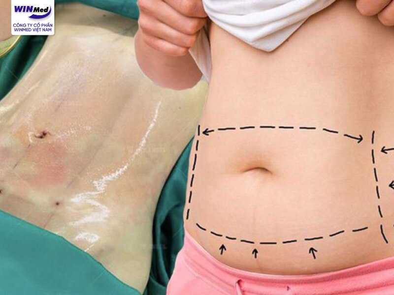 Những lưu ý khi sử dụng máy hút mỡ body jet