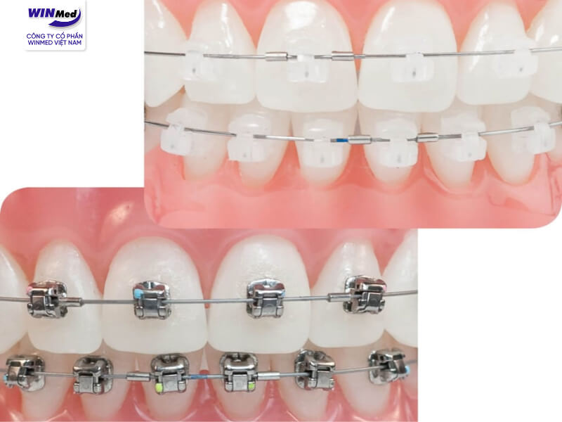 Tùy vào từng khách hàng để lựa chọn giữa mắc cài kim loại và mắc cài sứ
