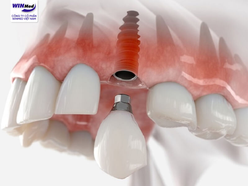 Thời gian tích hợp xương của dòng trụ implant khá nhanh, an toàn và tiết kiệm