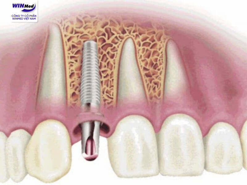 Trụ Implant M2 đang dần trở thành sự lựa chọn đáng tin cậy nhờ chất lượng ổn định, hiệu quả