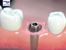 Trụ implant MSDI được đánh giá tích hợp xương tốt và lành vết thương rút ngắn thời gian