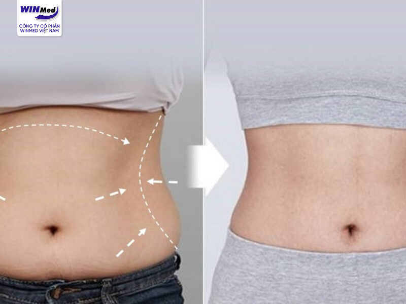 Winmed Việt Nam – Đơn vị phân phối chính hãng máy Body Jet uy tín tại Việt Nam