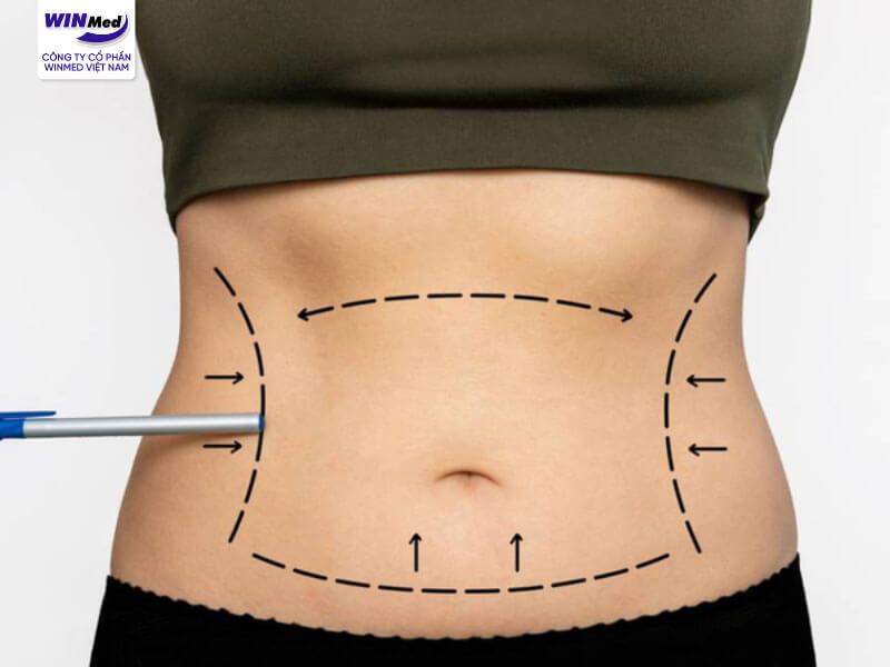 Việc lựa chọn máy hút mỡ Body Jet đem lại hiệu quả cao cho chất lượng dịch vụ