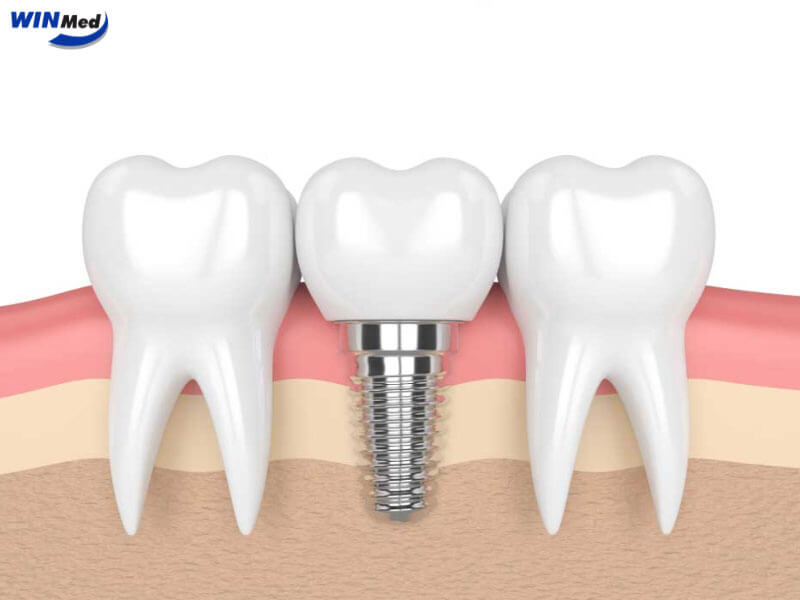 Chế độ ăn uống sau khi cấy Implant