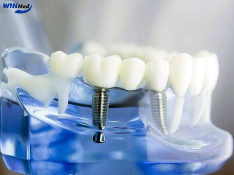 Vì sao Implant M2 được ưa chuộng