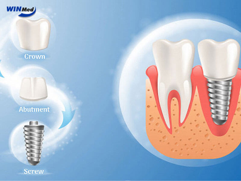 Bề mặt Implant được xử lý công nghệ cao