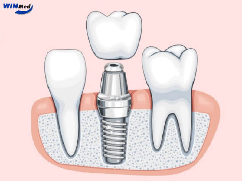Vật liệu Implant phải đạt chuẩn y khoa quốc tế