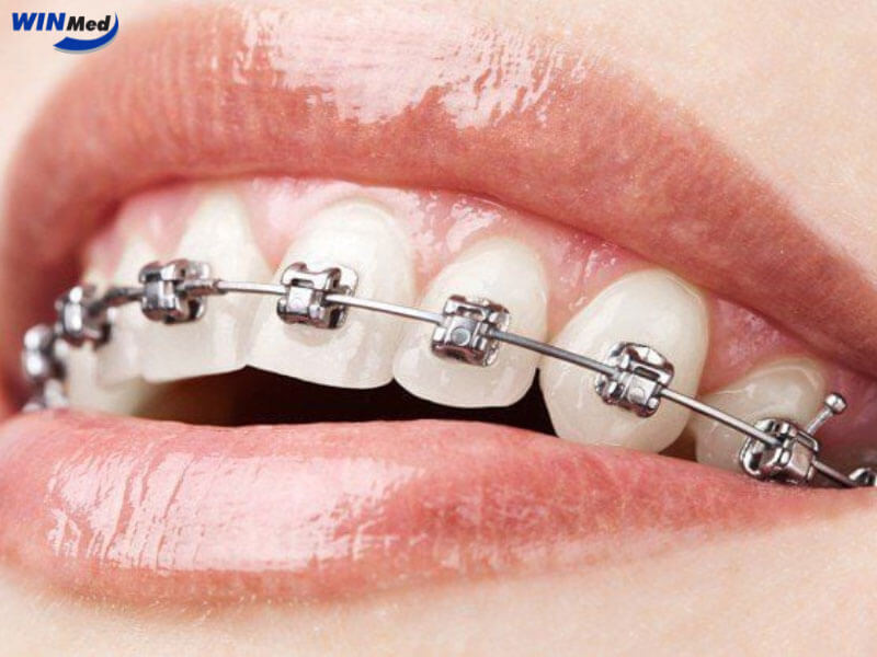 Mắc cài kim loại – Giải pháp truyền thống, hiệu quả cao