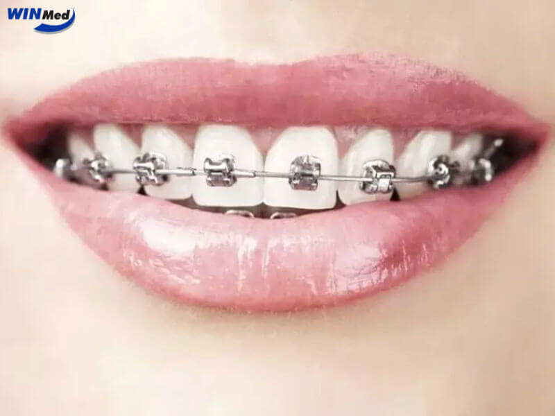 Mắc cài kim loại tự buộc – Rút ngắn thời gian điều trị