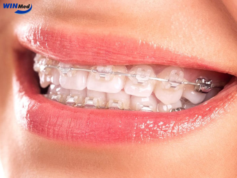 Mắc cài sứ thẩm mỹ – Giải pháp cho người ưu tiên ngoại hình