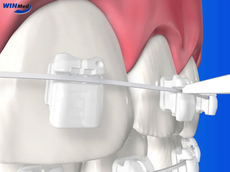 Mắc cài sứ tự buộc – Kết hợp giữa thẩm mỹ và công nghệ