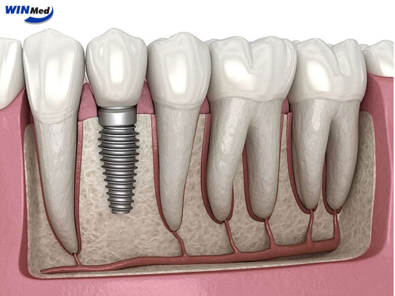 So sánh Implant M2 với nhu cầu thực tế của phòng khám nha khoa