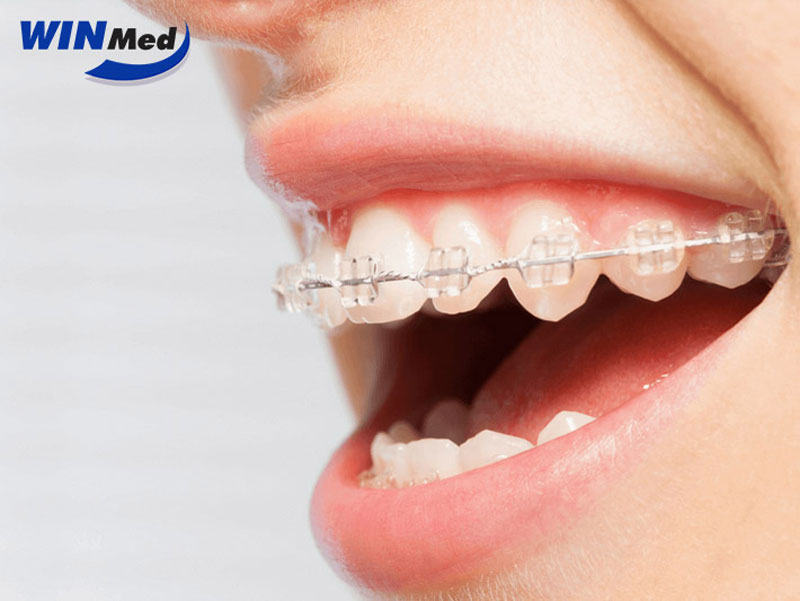 Vì sao mắc cài tự buộc ngày càng được các phòng khám nha khoa ưu tiên?