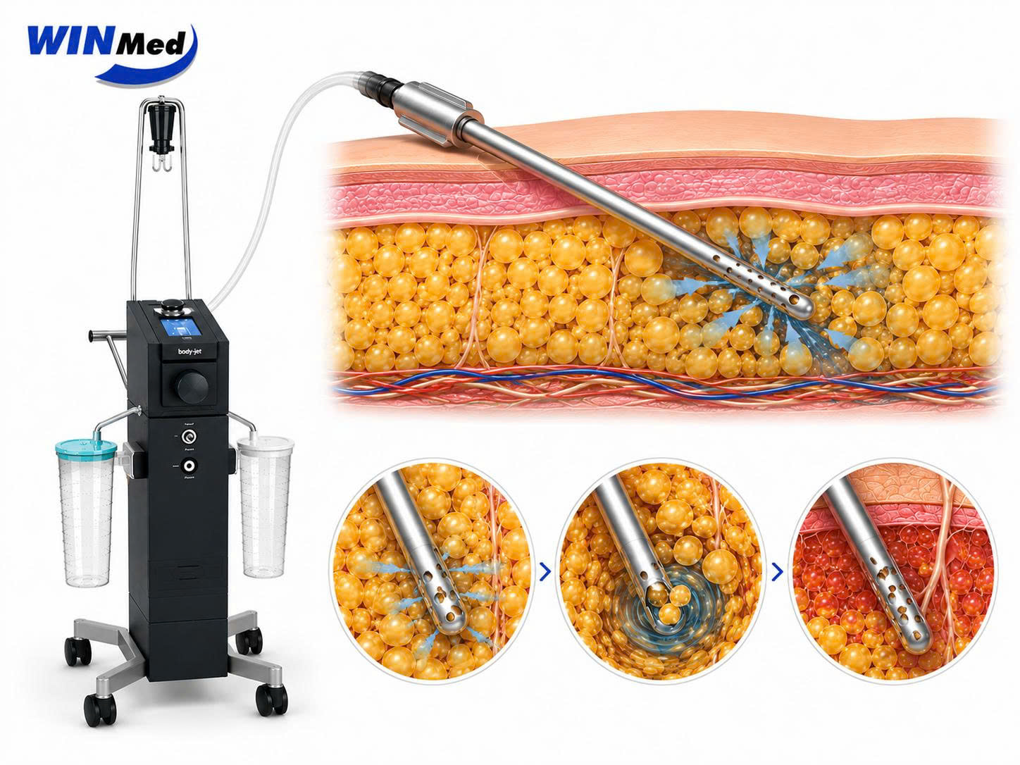 Cơ chế tách mỡ bằng tia nước của Body Jet