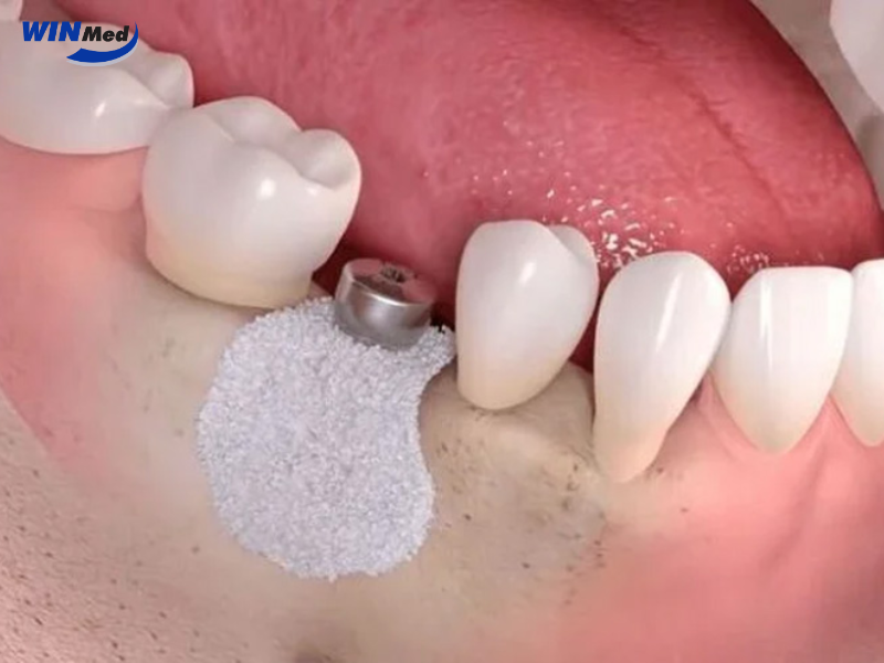 OSTEON Xeno ứng dụng trong GBR và nâng xoang Implant