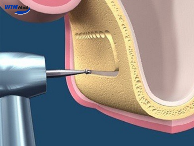 Bộ nâng xoang Implant hỗ trợ phẫu thuật nâng xoang