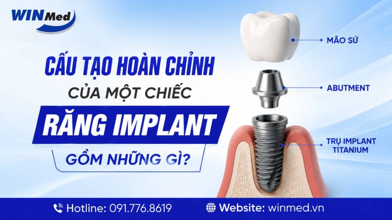 Trụ Implant Titanium - Nền Tảng Vững Chắc Của Chiếc Răng