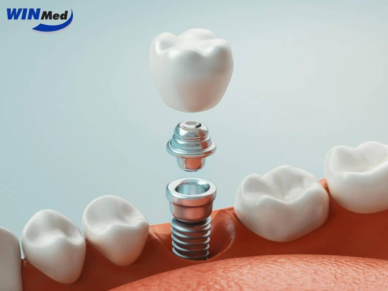Vì Sao Cấu Tạo 3 Thành Phần Giúp Implant Bền Vững?